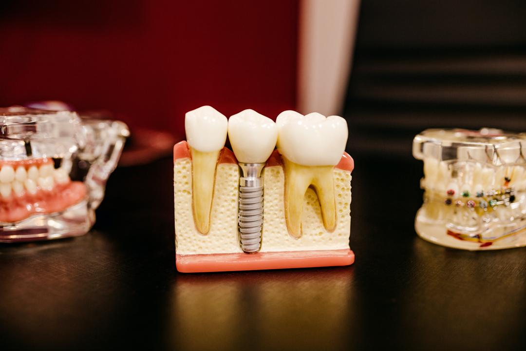 Імплантація зубів Straumann Osstem